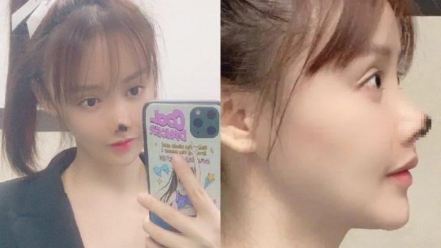 Ngeri! Hidung Artis Cantik Ini Membusuk Usai Operasi Plastik, Begini Potretnya