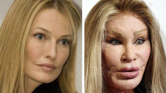 Malah Makin Aneh, Ini 7 Potret Before-After Artis yang Lakukan Operasi Plastik