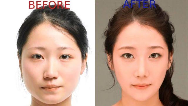 Ini Fakta Operasi Plastik di Korea Selatan! Gak Cuma Cewek Loh