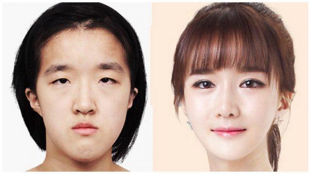 Gak Nyangka, Begini Jawaban Mengejutkan Orang Korea soal Operasi Plastik di Negaranya