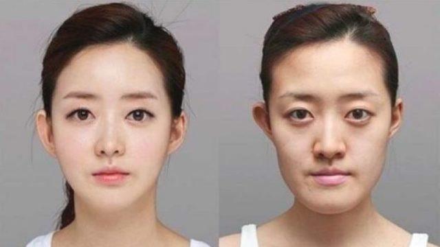 Jadi Hadiah Kelulusan dari Orang Tua, Ini 7 Fakta Mengejutkan Operasi Plastik di Korea