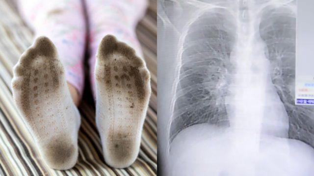 Aneh Tapi Nyata! Gegara Kecanduan Cium Kaus Kaki Kotor yang Sudah Dipakai, Paru-Paru Pria Ini Jadi Begini