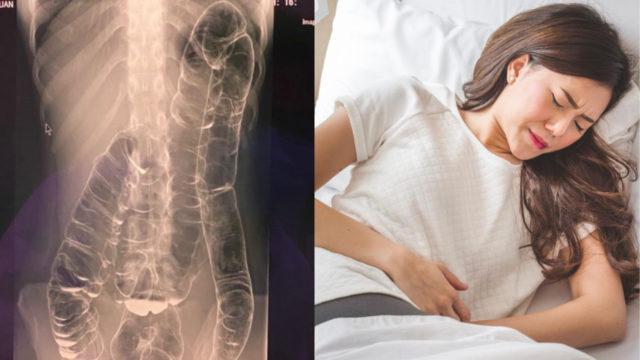 Ngeri! Susah 'Pup' Sejak Kecil, Usus Wanita 23 Tahun Ini Naik Sampai ke Jantung